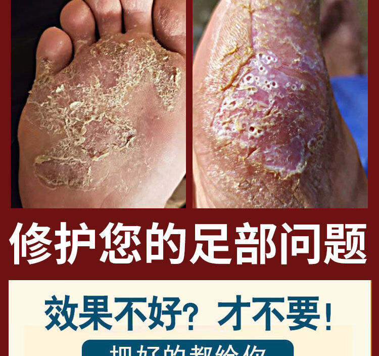 脚气王软膏脚痒脚气膏偏方水泡复发止痒脱皮脚汗软膏轻度症状20g一盒