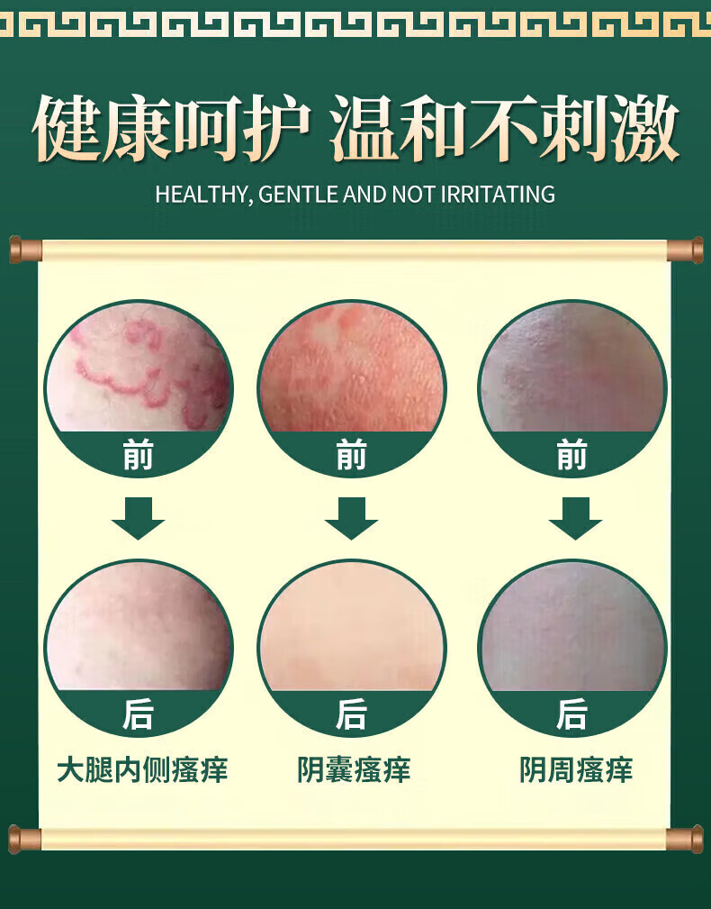 修正阴囊潮湿瘙痒阴囊炎睾丸瘙痒湿疹膏瘙痒阴囊止痒双效型初期肛门大腿内侧皮肤瘙痒止痒男性 一套初期装（双效型） 可搭阴囊男人专用止痒去根使用详情图片17