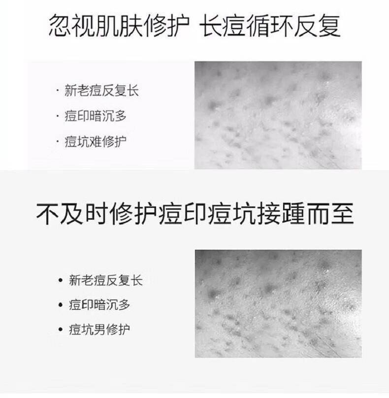内廷上用祛痘印去痘坑去痘疤痘印痘坑修护复凹洞黑色素沉淀淡化 一盒体验装【拍二發三】