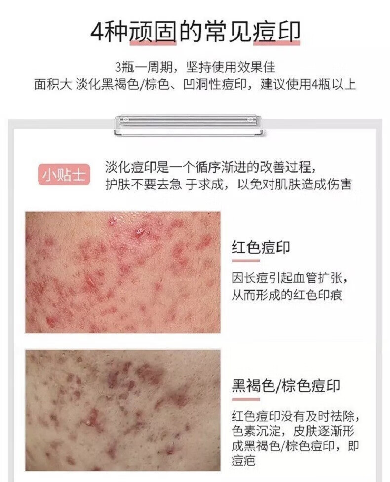 内廷上用祛痘印去痘坑去痘疤痘印痘坑修护复凹洞黑色素沉淀淡化 一盒体验装【拍二發三】