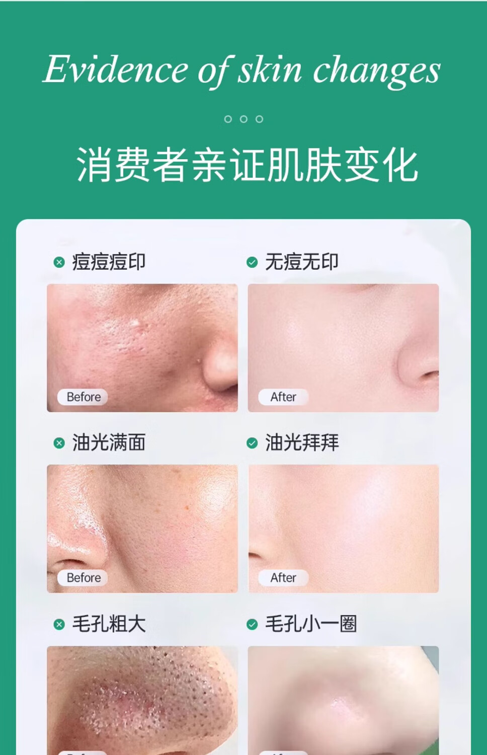 BIGLY水杨酸面膜控油淡化痘印去黑头闭口粉刺深层清洁收缩毛孔涂抹面膜 水杨酸面膜150g一瓶装