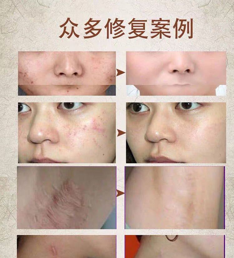 疤痕疙瘩胸前 疤痕净护理软膏【图片 价格 品牌 报价】-京东