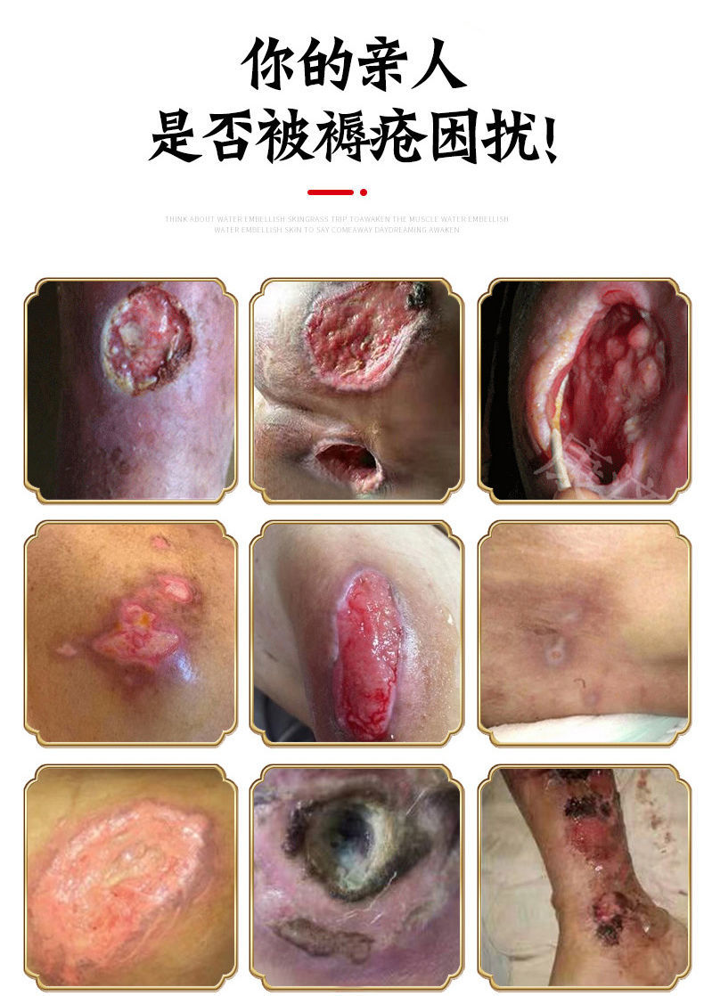 褥疮膏苗方生肌膏去腐拔毒老人压疮黑痂老烂腿糖尿足拔毒伤口愈合 1