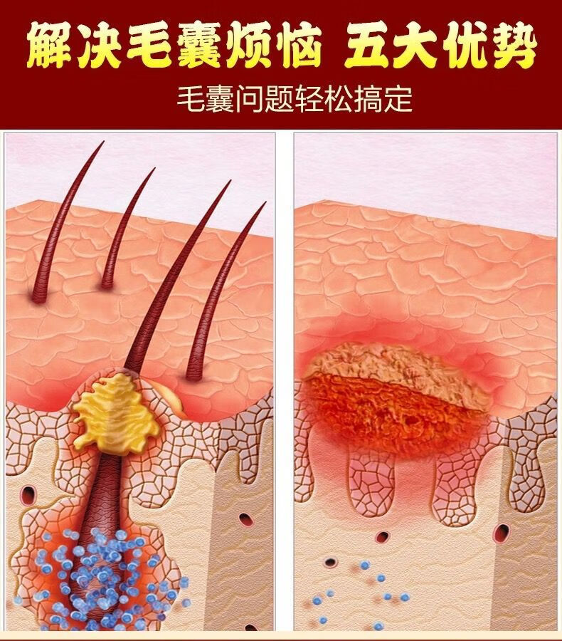 胸口四肢去除皮囊l炎祛痘痘皮膚瘙癢止癢膏膿包痤l瘡糠秕孢子菌性專用