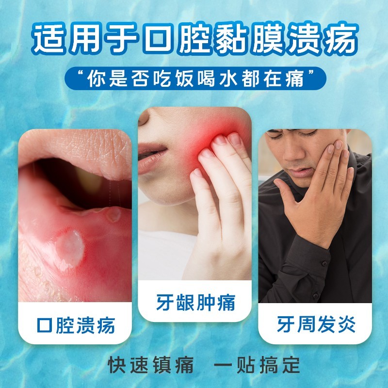 意可贴 醋酸地塞米松口腔贴片 0.