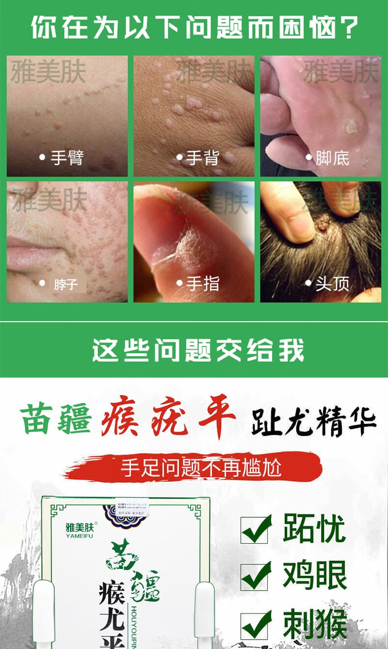 疣瘊平去除子瘊去除面部脸部疣扁平手足部疣趾去刺瘊去眼鸡膏男女疣常