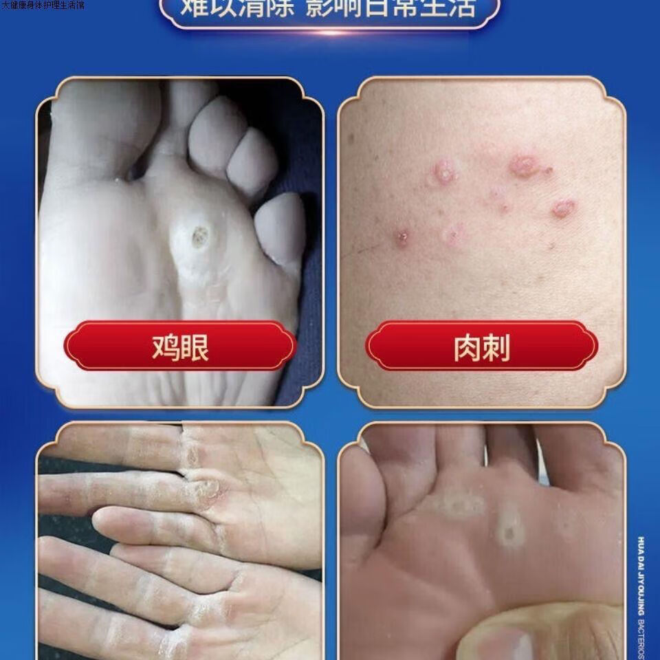 花带2号 鸡尤净鸡眼膏老茧肉刺鸡眼脚垫硬皮趾疣膏官方 花带2号 花带2