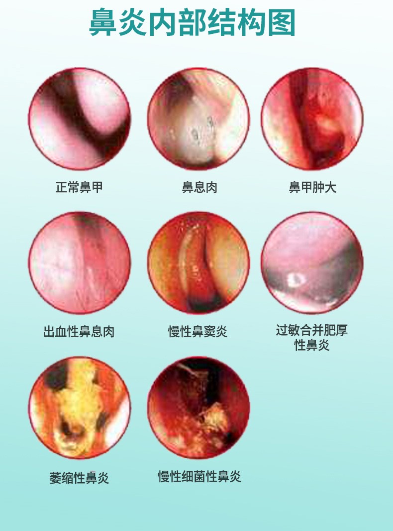 正常鼻子内部图片图片