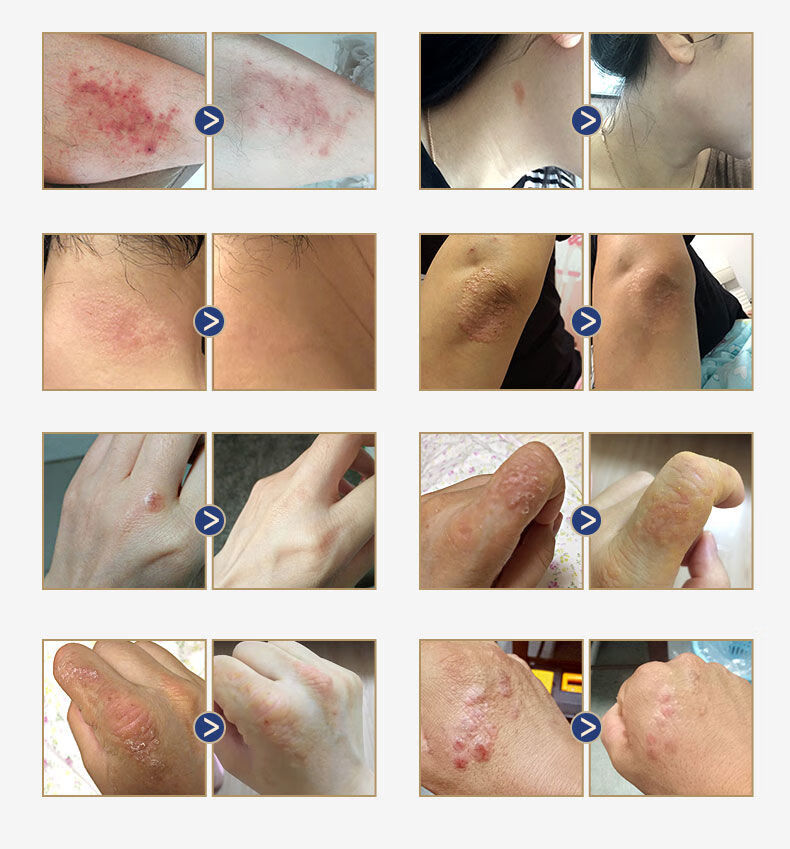 伊夏【官方自营】京康恩皮肤乳膏 京康恩草本皮肤止痒