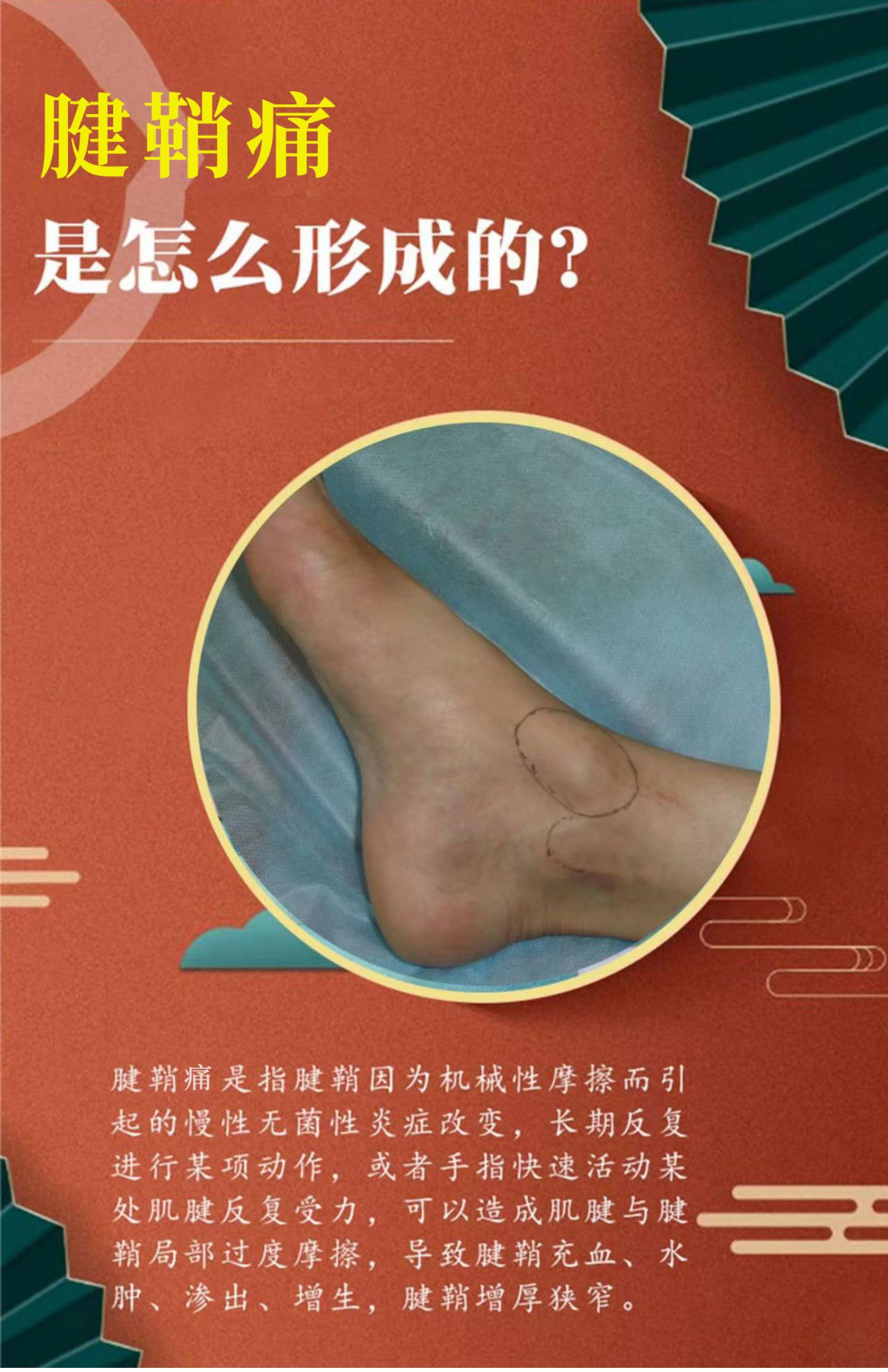 腱鞘專用腳背腫痛腱鞘鼓包腳背疼痛關節腫痛冷敷凝膠推薦輕度疼痛發3