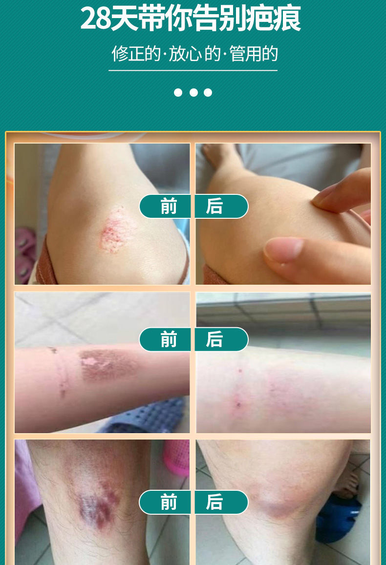 膏祛痘印膏去除脖子黑棘皮颈部腿黑色素晒伤修复晒后修复膏乳霜修复祛