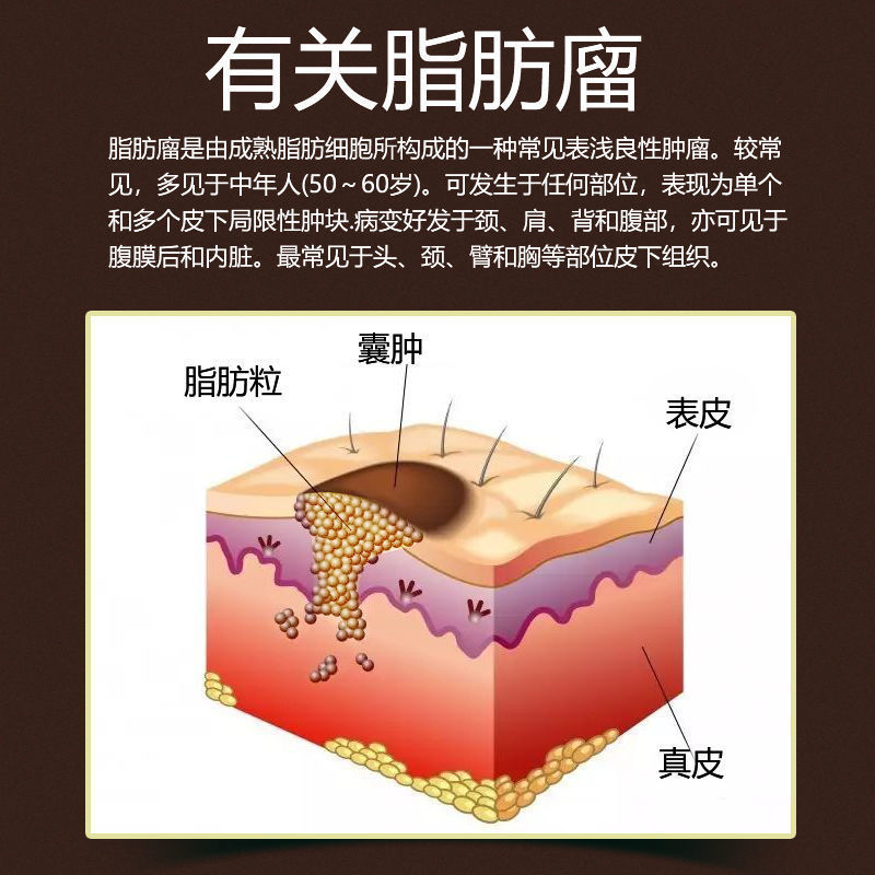 骶尾部脂肪瘤图片图片