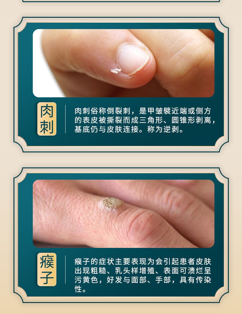 疣咪喹莫克温和去除丝状疣脖子颈部小肉粒疙瘩肉赘皮赘寻常尤病毒瘊子