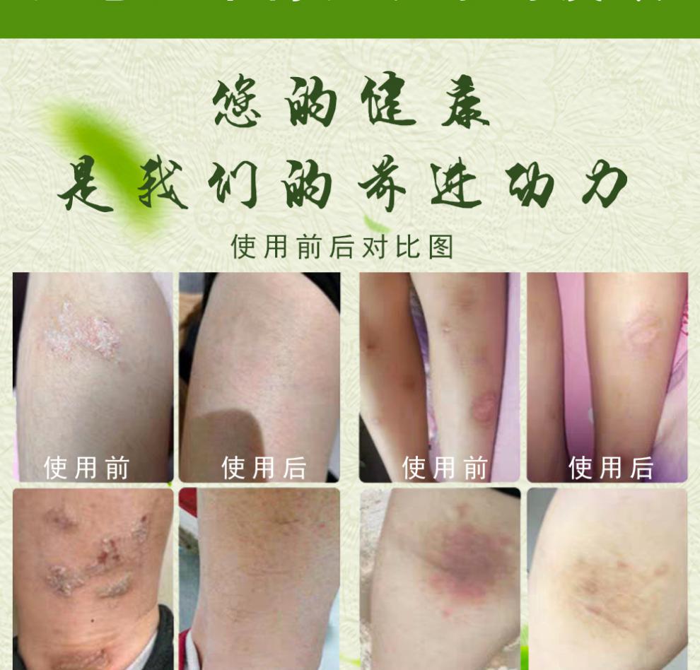 【京选优物】深山奇方倍妙春藏宝皮独清乳膏皮毒清癣尼肤坤软膏止痒