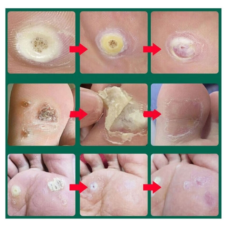 【官方旗舰】悠u博士刺猴专用脚底疣瘊净趾甲周疣膏贴去除疣跖根