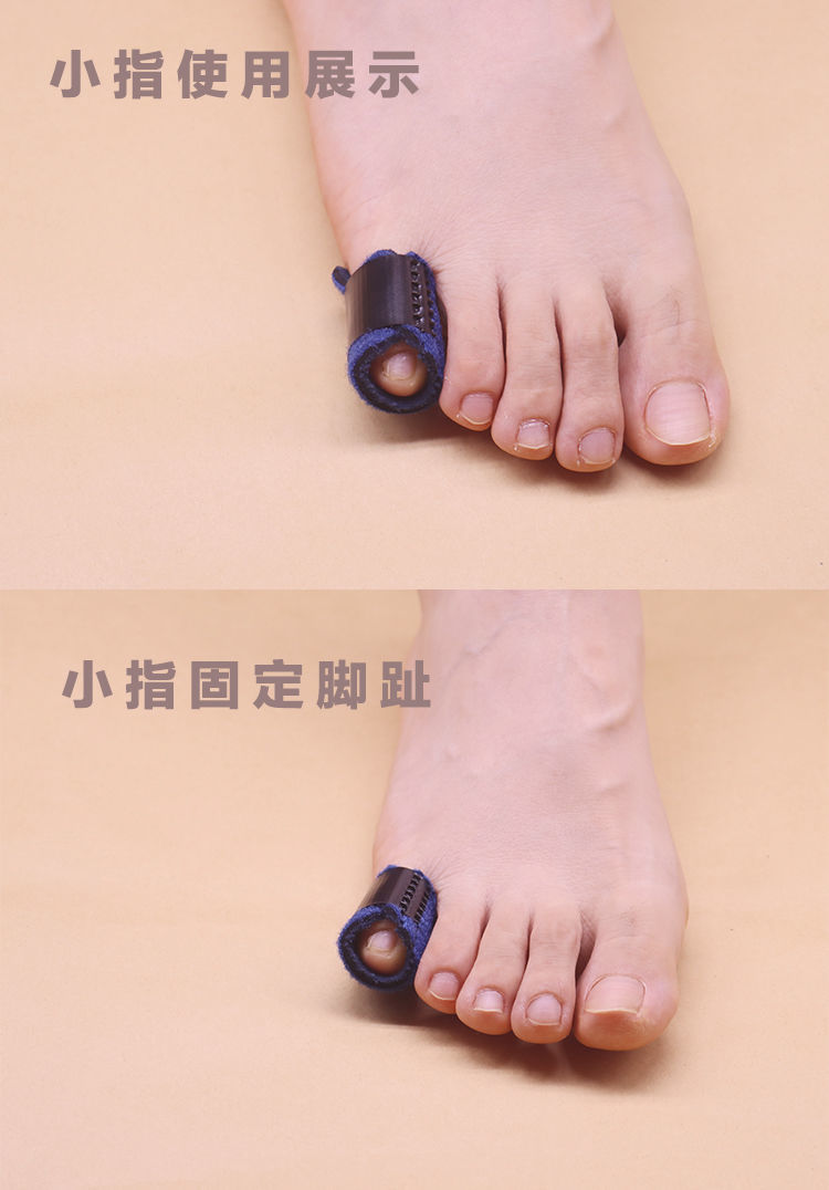 阙时翊脚趾骨折固定支具食指锤头趾弓趾抓地脚趾肌腱短萎缩骨折固定器