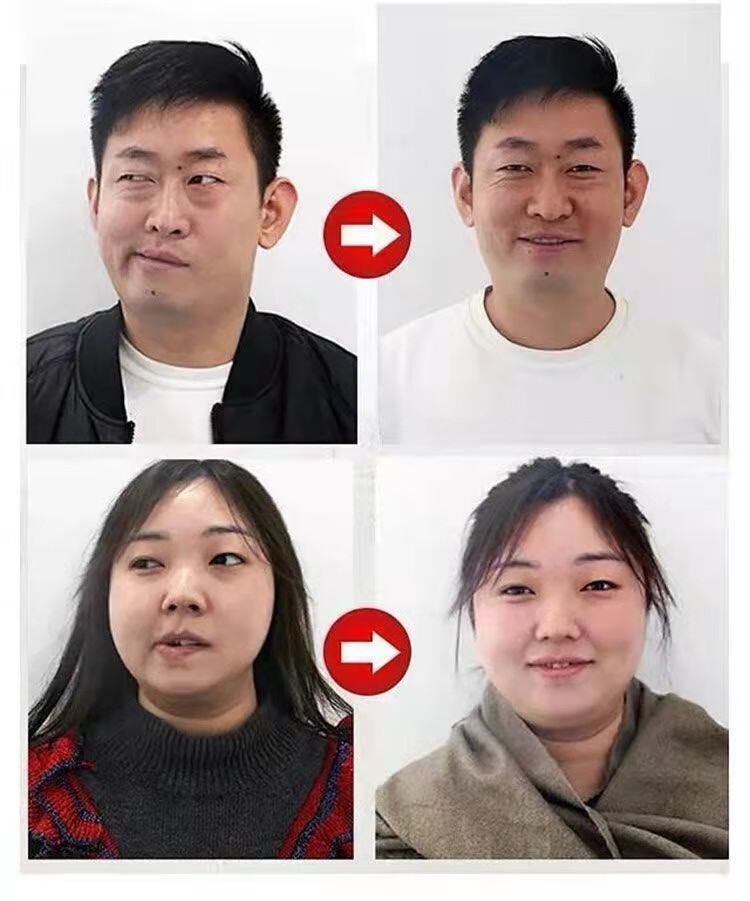 面瘫贴歪嘴眼斜面部麻木僵硬后遗症面部牵正贴面肌痉挛萎缩面瘫专用牵