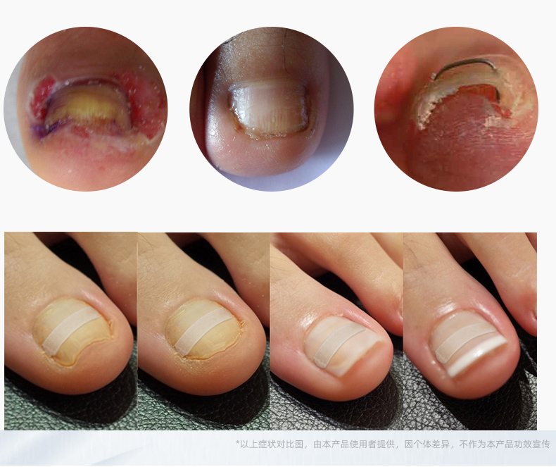 甲沟炎膏矫正器治疗软甲消炎消肿去肉芽甲沟炎息肉去除神器 单盒装(10