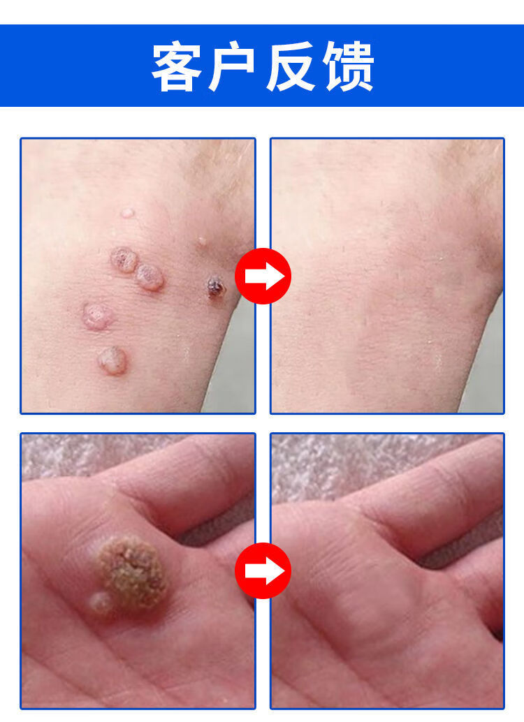 克优膏尖锐丝状寻常扁平忧足部霜手足疣灵疣疣净膏 一支装【草本提取