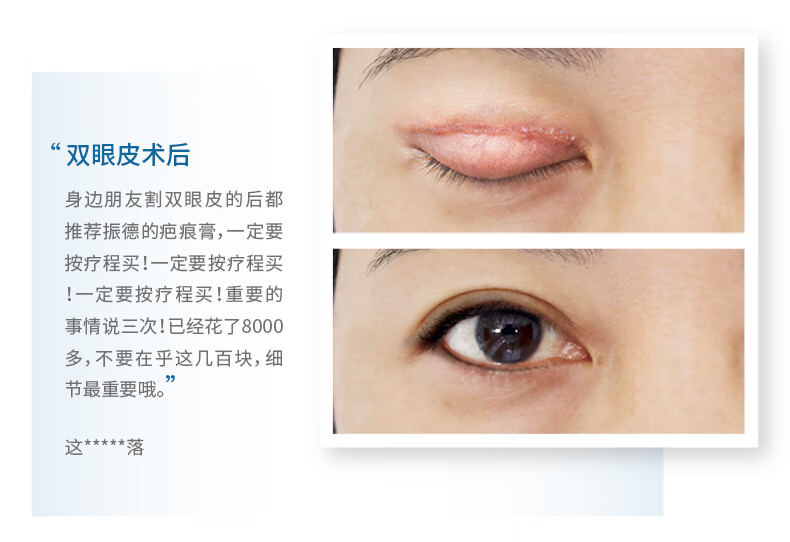 祛疤膏增生疤痕贴修复去疤贴脸部硅酮凝胶敷料手术剖腹产硅酮疤痕膏20