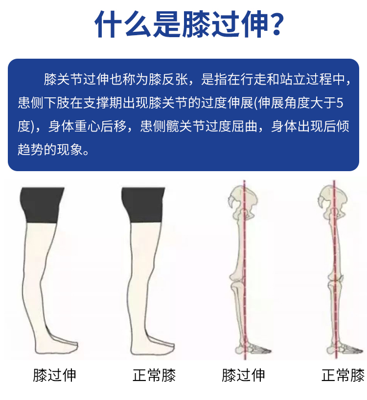 兒童護膝寶寶膝過伸矯形器膝反張膝關節韌帶鬆弛糾正保護康復用具l