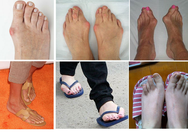 脚指头矫正器拇指外翻矫正器硅胶 大脚趾头纠正日夜用成人可穿鞋大