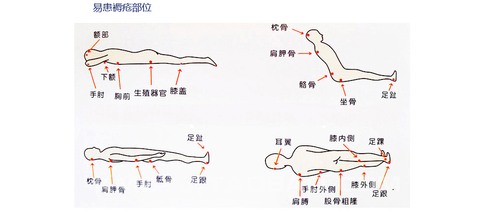 压疮好发部位的示意图图片