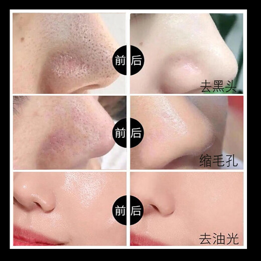 九叶草竹炭黑头面膜清洁油脂粉刺收缩毛孔t区护理涂抹式鼻贴男女士通用 1瓶装