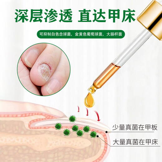Correct onychomycosis antibacterial liquid, non-special effect, deck thickening and discoloration, nail groove fungal infection, impatiens sterilization and nail removal, 1 bottle of onychomycosis antibacterial liquid, mildly applicable