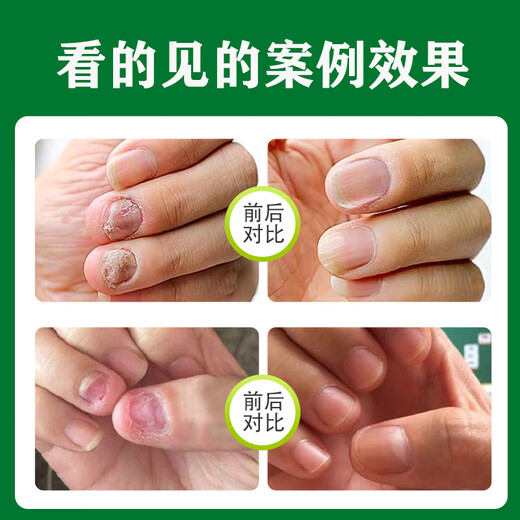 Correct onychomycosis antibacterial liquid, non-special effect, deck thickening and discoloration, nail groove fungal infection, impatiens sterilization and nail removal, 1 bottle of onychomycosis antibacterial liquid, mildly applicable