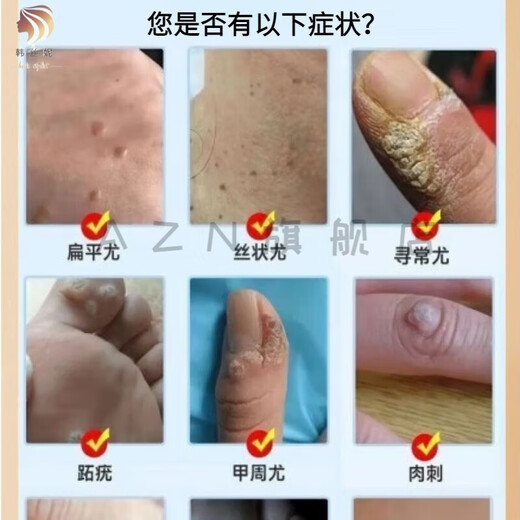 【草本尤皂】去祛疣皂全身皮肤问题肉粒手足多种尤护肤手工皂 A688倍效【强效装】
