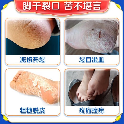 Hong Kong Pharmacy Cracked Heels Cream Fungal Infection Cracked and Peeling Feet Cracked Anti-Crack Moisturizing Moisturizing Foot Cream w1 in a box with quick results