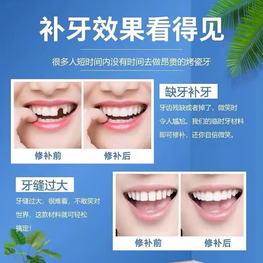 Filling materials: self-filling imported nano-resin, self-blocking cavities at home, repairing cavities and bad tooth fillings, 1 box, trial pack, 10 fillings