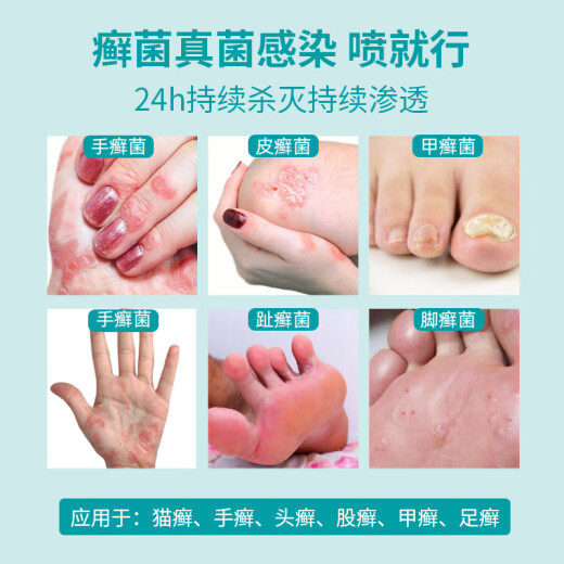 
99309930 Skin Disinfection Spray Spray Ash Disinfection Fungus Bacteria Itchy Pain Skin Infection 50ml/bottle 9930 Skin Disinfection Spray 50ml