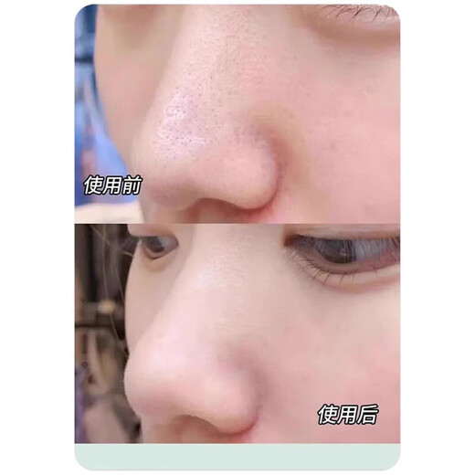 Scrape away blackheads. Portable blackhead scraper. Manual acne facial cleansing hair follicles and pores. Magic tool to remove blackheads. Scraper for face shaving. Small blackhead shovel. Portable. 1 pack - beauty spatula. Just scrape away + say goodbye to blackheads.