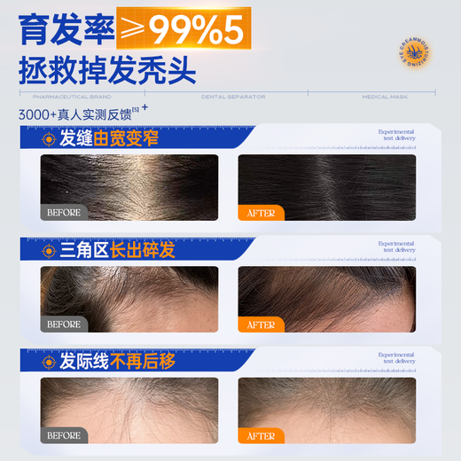 OHBT hair growth serum 100ml anti-hair loss solid agent thickening hair activation hair growth hair follicle scalp care essence for men and women