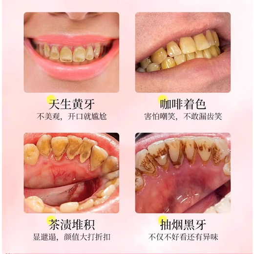 SMILEKIT日本美白牙贴去黄牙去牙渍烟渍牙贴美白牙齿去牙黄炫白变白牙贴片 1盒装【14片=7对】