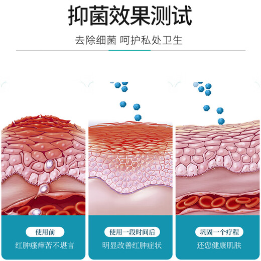 Antibacterial cream to correct itching in private parts, bacterial infection in vulva, men and women, gynecological testicular itching, remove moist thighs, non-itching and sterilization, 1 box of Fukang Antibacterial Cream (mild itching), use on private parts, thighs and whole body