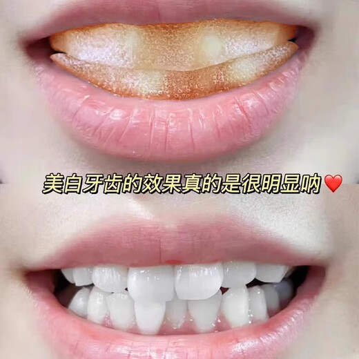 SMILEKIT日本美白牙贴去黄牙去牙渍烟渍牙贴美白牙齿去牙黄炫白变白牙贴片 1盒装【14片=7对】