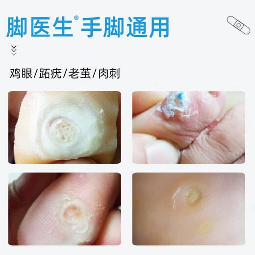 Pediatric doctor corns patch corns ointment for adults to remove foot thorns, toes, calluses, and foot pads to fall off