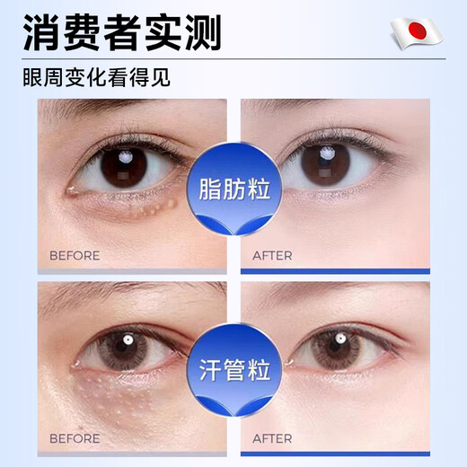 H18日本颗粒清肌眼霜脂肪粒去除眼部专用非药膏汗管去除药膏男女专用