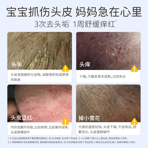 Akasugu爱舒屋婴幼儿去头垢精华液50ml宝宝护发软化头垢奶痂温和头皮护理
