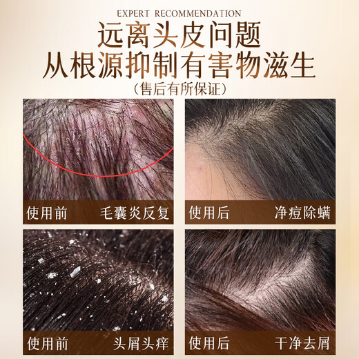 HIEUAILR德国进口原料洗发水男女专用除螨祛痘去屑止痒控油持久蓬松洗发露 【控油除螨祛痘】808ml*1