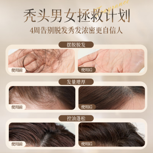 Qingzitang Prevención de jengibre y desarrollo de cabello de cabello Lea de orquidontic que restringiera al cabello resistente al control de aceite resistente a la picazón resistente a la duración de 500 ml
