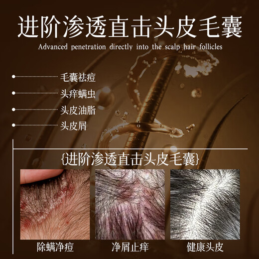 HIEUAILR德国进口原料洗发水男女专用除螨祛痘去屑止痒控油持久蓬松洗发露 【控油除螨祛痘】808ml*1