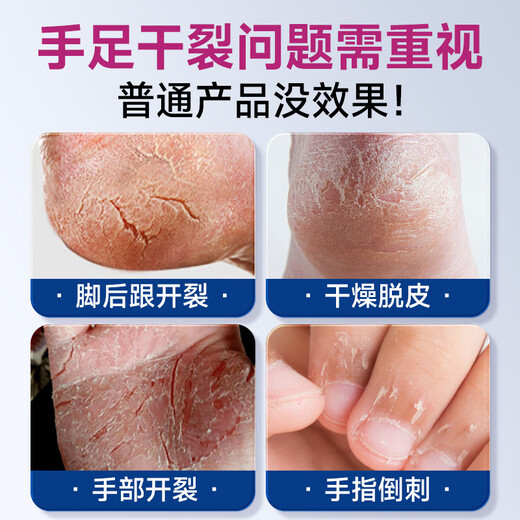 Half a bottle of Huachanning Hand and Foot Anti-Crack Cream for Cracked Feet, Cracked Hands, Cracked Heels, Cracked Skin Cream, Cracked Foot Cream 50g