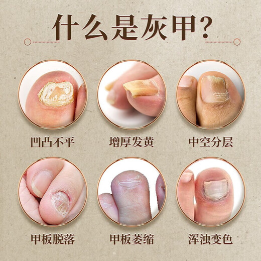 Guangyao Baiyunshan onychomycosis 100% special effect medicine No. 1 nail fungus infection removal onychomycosis root I treatment imported severe special effects in a box