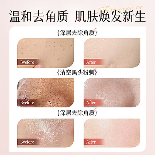 Vetes Peeling Gesichtsgelölkontrolle feuchtigkeitsspendende Gesichtsreiniger Männer und Frauen reinigen Poren mit Schwarzkopf geschlossener Mund ohne Hormone und [6 Hauptpatente] Fruchtsäure -Peeling Gel 200g