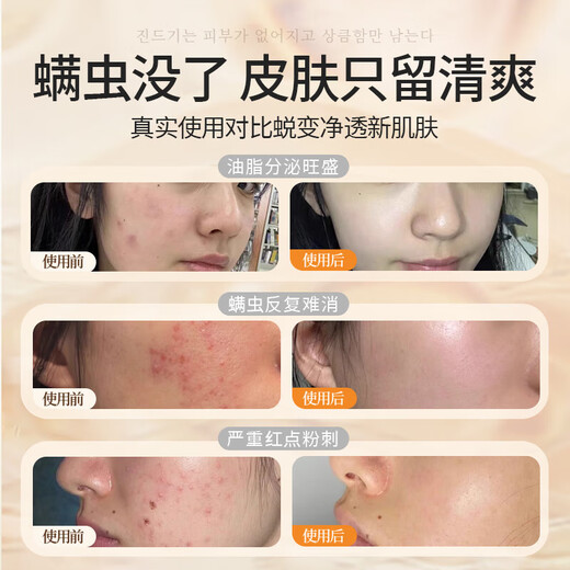 Qingyan sulfur facial cleanser oil control moisturizing and mites removal and blackhead removal for men and women universal facial cleanser face wash soap 2 packs