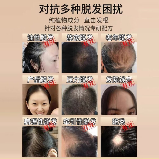 南京同仁堂防脱育发洗发水生姜洗发露头发增长密固发增长脂溢性脱发严重男女 一瓶装400ml【医师认证】